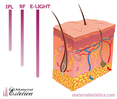 Luz pulsada intensa (IPL) vs depilación láser – Larouge skincare