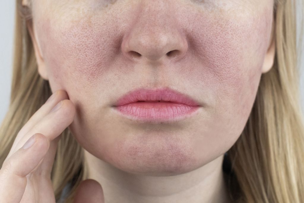 La mejor rutina facial para piel grasa. Conoce tu piel y cuídala